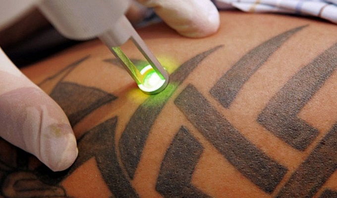How to Remove a Tattoos